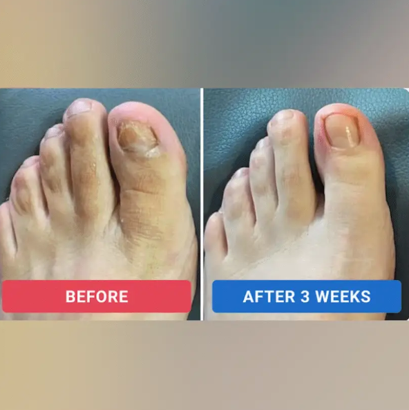 FUNGIMED™ - Fungal Nail Renewal Patches